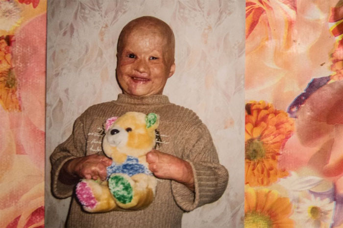 Babası yanan odun fırınının içine attı kardeşi öldü kendisi işte bu halde - Resim: 1