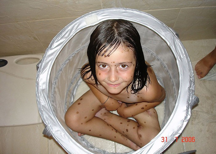 500 doğum lekesi ile doğdu ama  manken oldu - Resim: 3