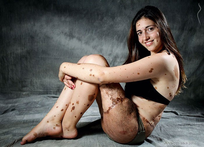 500 doğum lekesi ile doğdu ama  manken oldu - Resim: 4