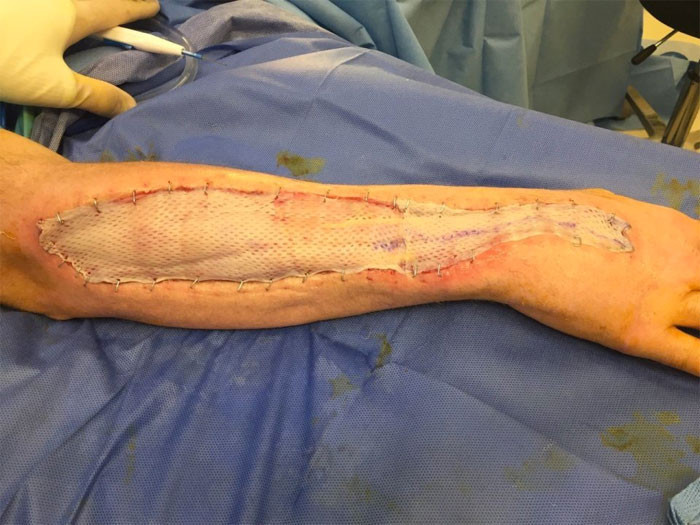 Et yiyen bakteri kolunu yiyor 1 haftada kolunun yarısı gitti - Resim: 2