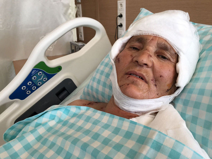 9 köpek saldırdı kafasındaki saç derisinin üçte ikisi yok - Resim: 2