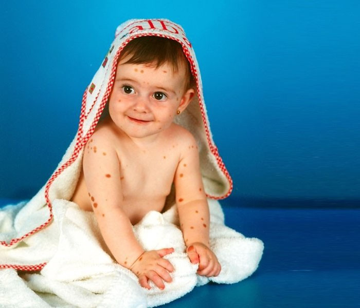 500 doğum lekesi ile doğdu ama  manken oldu - Resim: 2