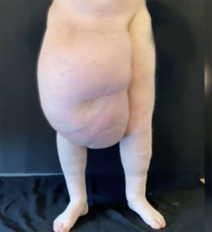 Görüntü inanılmaz! Kasığından 35 kiloluk kitle çıktı görenler inanamadı - Resim: 2