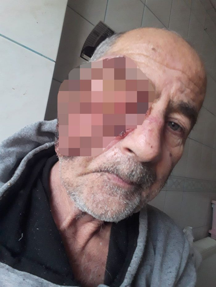 Yüzü eriyor yarası gittikçe büyüyor yaşlı adam hastane koridorlarında yatıyor - Resim: 2