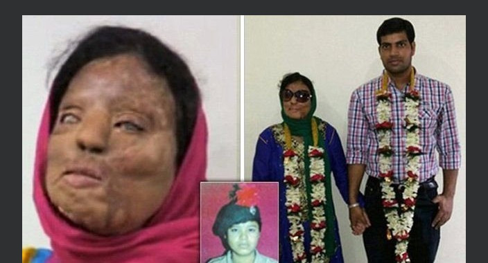 Asit saldırısına uğradı hayatı mahvoldu! - Resim: 1