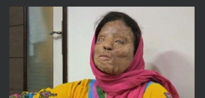 Asit saldırısına uğradı hayatı mahvoldu! - Resim: 2