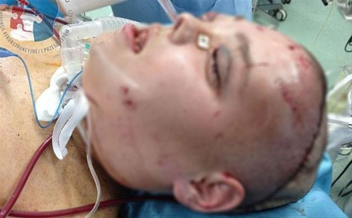 Yüz nakli sonrası inanılmaz değişim! Yok artık diyeceksiniz - Resim: 3