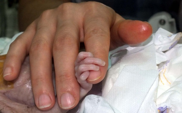 Parmak bebek hayata tutundu - Resim: 4