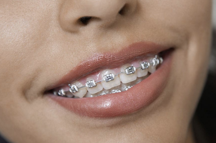 Diş telinden haz etmeyenlere müjde! Bu iki yöntemi deneyin - Resim: 1