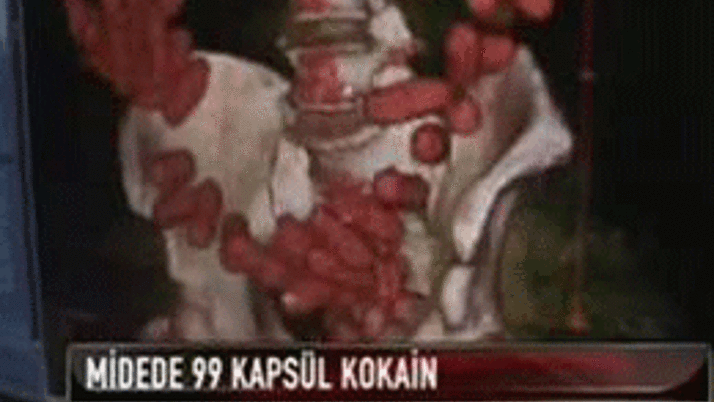 Midesinden 99 kapsül kokain çıktı