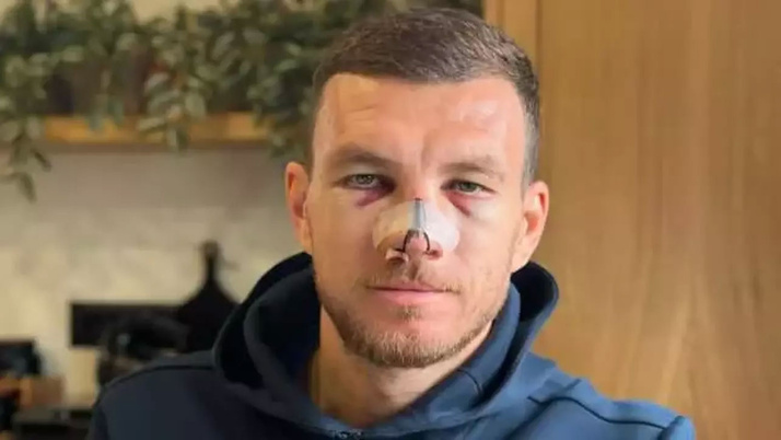 Burnu kırılan Edin Dzeko ameliyat edilecek mi?