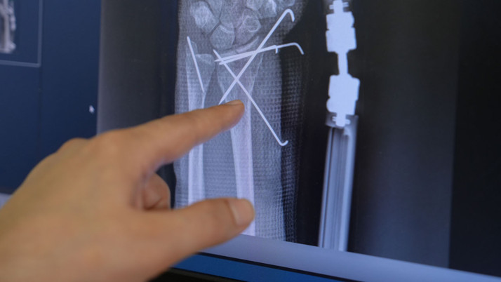 66 yaşında kalçasını ve el bileğini kırdı bir haftada Medipol’de ayağa kalktı