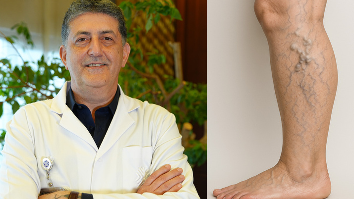 Özellikle kadınlarda görülüyor! Varis artık sorun değil bu yöntemle hızlıca iyileşmek mümkün