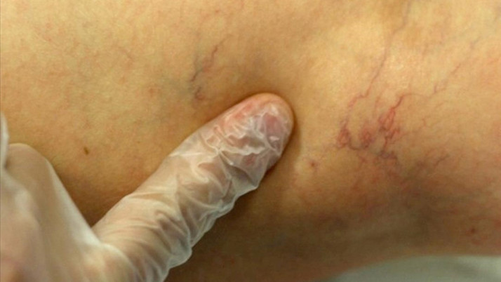 Ağrısı geçsin diye bacağına sardı sonra olanlar çok feci