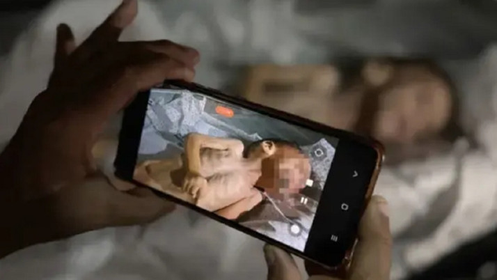 Açlık sınırları zorluyor! 3 Kiloya kadar düşen çocuk yaşamını yitirdi...