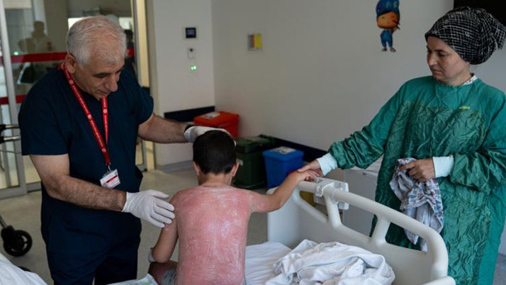 Güneşte 4 saat kalan çocuk, ikinci derece yanık oldu