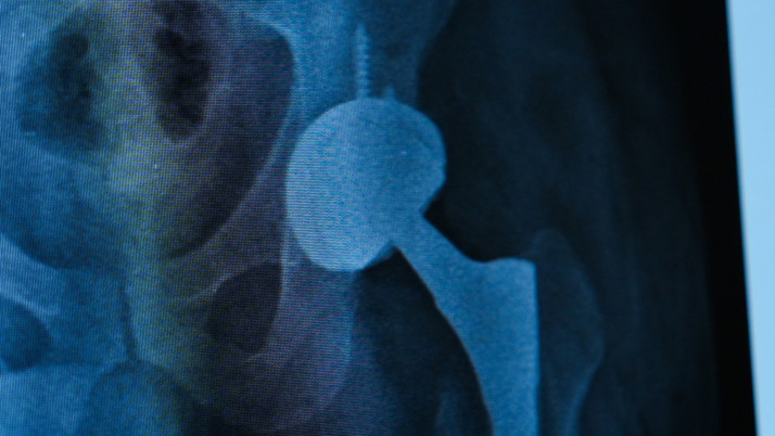 Dört yıllık ağrılı yaşam tek ameliyatla bitti! Protez değişimi nasıl uygulanıyor?