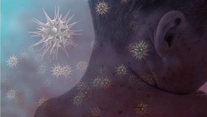 Kızamık vakası can aldı! 17 Kişi hayatını kaybetti...