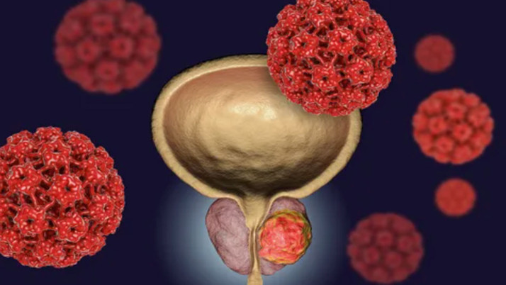Erkeklerde en çok bu kanser türü görülüyor, aman dikkat!