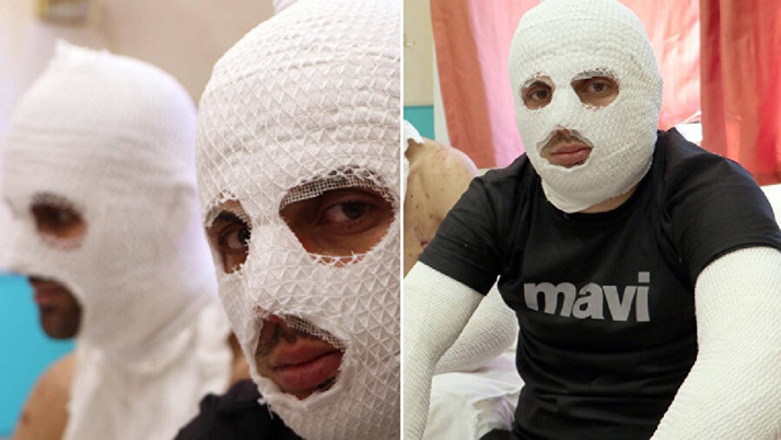 Erzurum'da görülmemiş olay! Araçtaki çakmak tüpü patladı, 2 yaralı