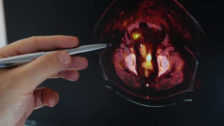 Obezite ve kanser arasındaki tehlikeli bağ!