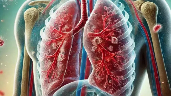 DSÖ'den korkutan rapor! Tüberküloz nedeniyle her yıl bir milyon kişi hayatını kaybediyor