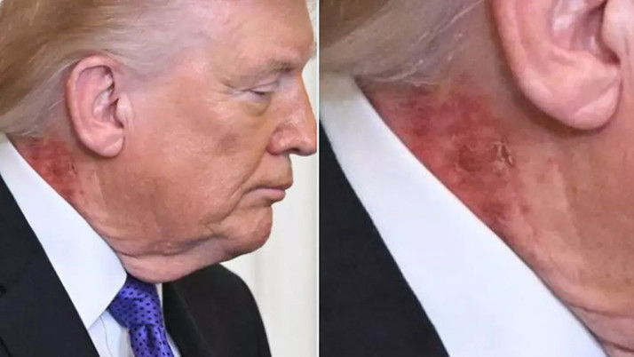 Trump'ın boynundaki ve elindeki kızarıklık olay oldu! Beyaz Saray'dan jet açıklama geldi
