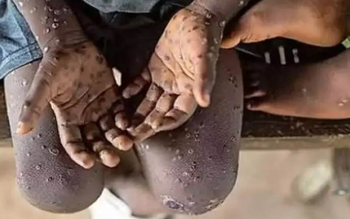 Afrika'da maymun çiçeği kontrolden çıktı