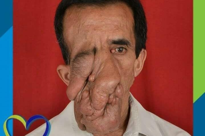 60 yıl yüzündeki 25 kilo tümör ile yaşadı 5 ameliyat geçirdi! Yıllar sonra huzura erdi - Resim: 2