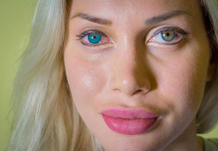 Belini inceltmişti şimdi de operasyonla göz rengini değiştirdi!  - Resim: 2