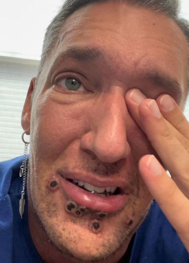 Maymun çiçeği virüsü Türkiye'de! Belirtileri neler? Hastalar anlatıyor: Acıdan çığlık atıyordum - Resim: 3