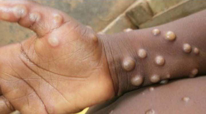 Yeni kabus maymun çiçeği virüsü şimdi de Almanya'da Dünya Sağlık Örgütü acil toplantı kararı aldı - Resim: 3