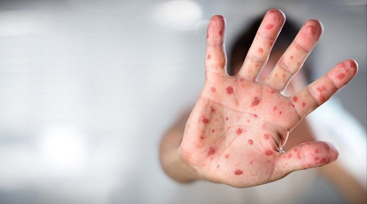 Maymun çiçeği virüsünde korkulan oldu! Avrupa'da ilk ölüm vakası! - Resim: 1