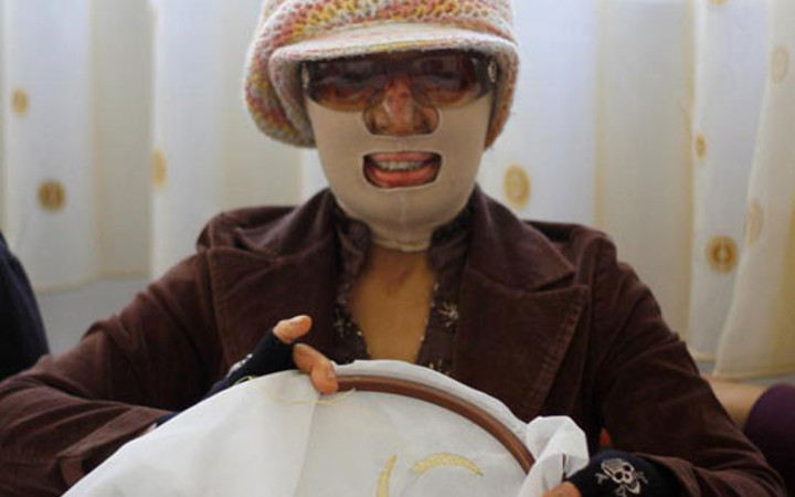 Yüzü yanan kadın ailesinin desteğiyle hayata tutundu