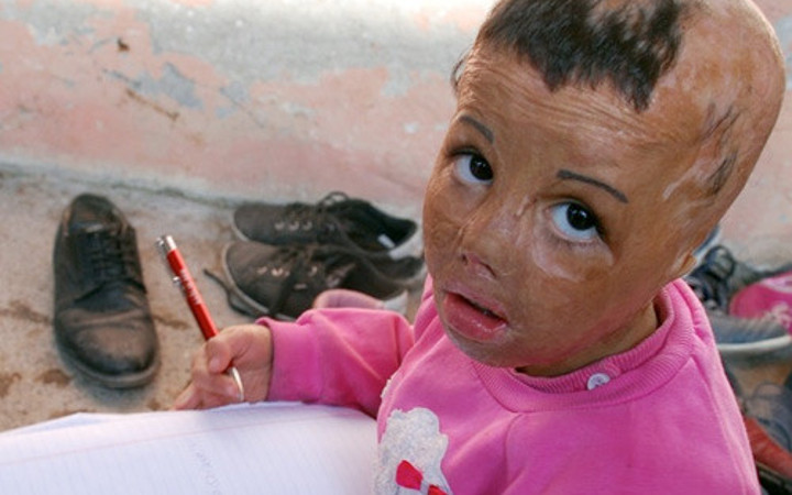 6 yaşında 7 kez ameliyat olan Rezzan'ın dramı