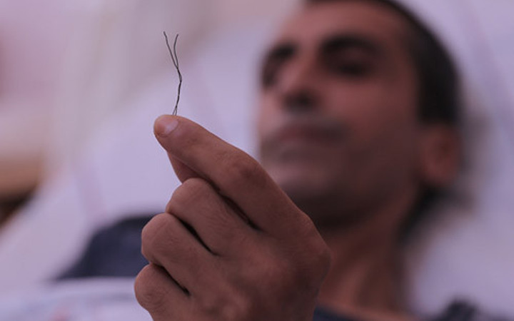 Doktor bile şok oldu bağırsaktan çıkana bakın