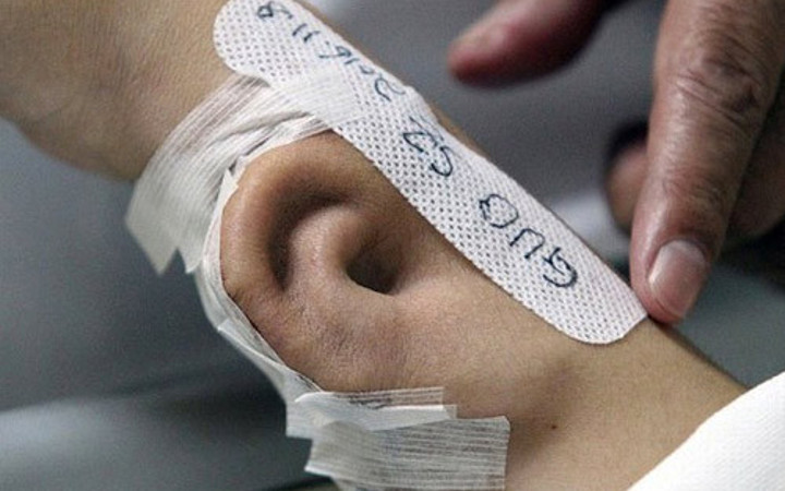 Kulağı tamamen parçalanmıştı mucize estetik