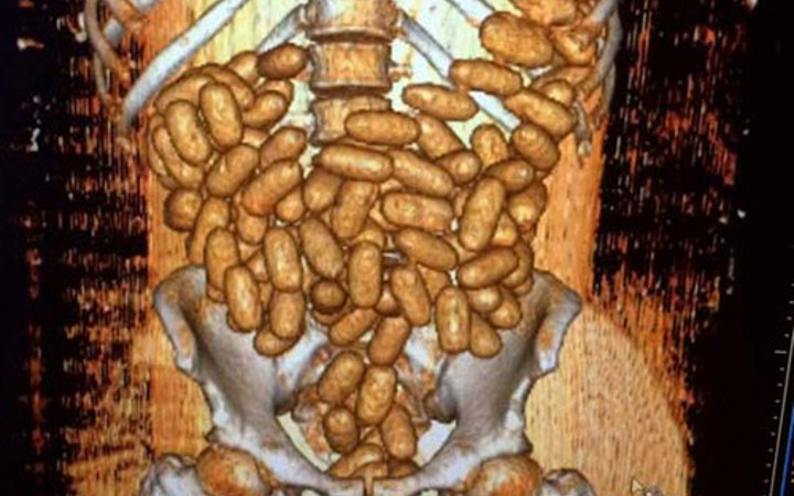 Sindirim sisteminde 115 prezervatif bulundu