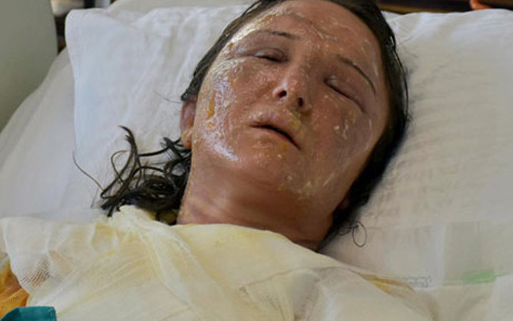 Kaynana dehşeti! Gelinin yüzüne kızgın yağ döktü