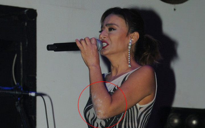 Yıldız Tilbe'nin kollarına ne oldu? 