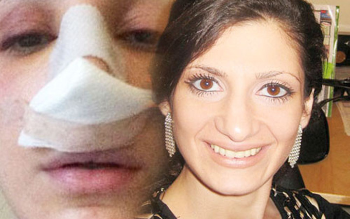 Burun estetiği yaptırdı şimdi nefes alamıyor