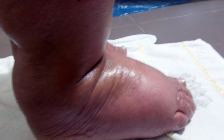 31 yıl sonra fil hastalığını yendi