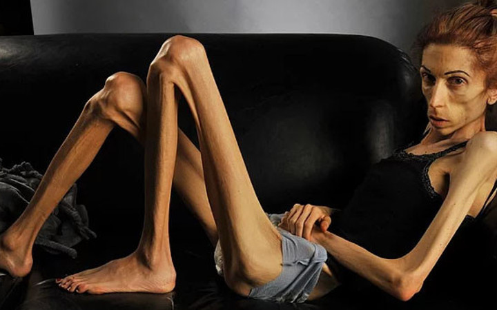 Zayıflamak için 18 kiloya düştü! Haline bakın