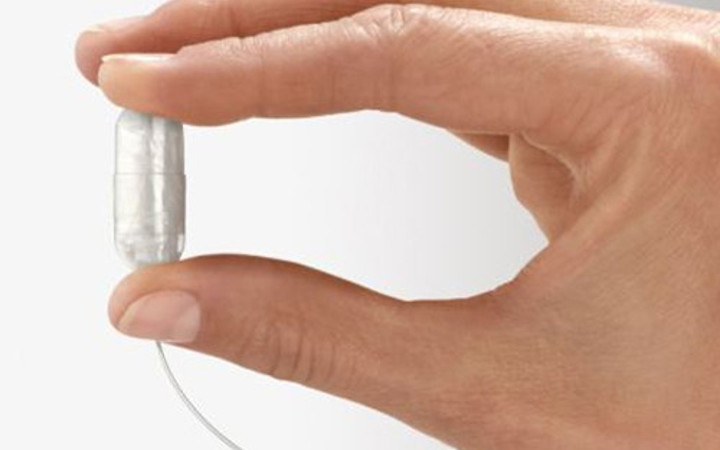 Balon haplarla zayıflamak mümkün mü?