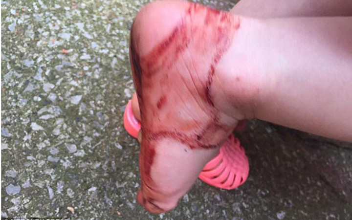 Sadece yarım saat giydi ayağı bu hale geldi!