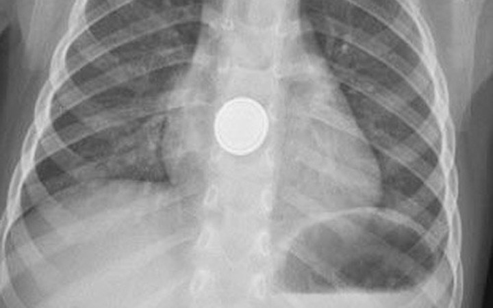 Küçük Efe pil yutunca olanlar oldu