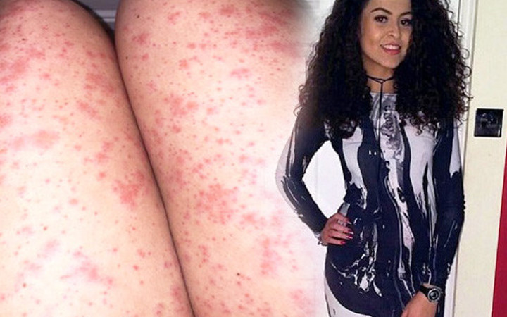 Epilasyondan tahriş oldu sandı kanser çıktı!