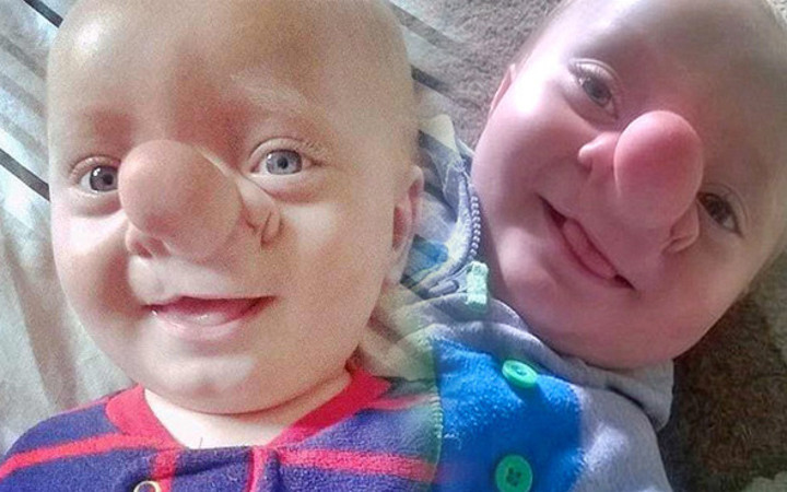 Bebeği bu halde dünyaya geldi görenler gözlerine inanamadı 3 yıl sonra...