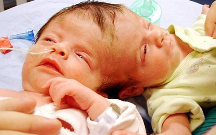 Bu halde dünyaya geldiler 'benzersiz ikizlere' bakın ölene kadar...