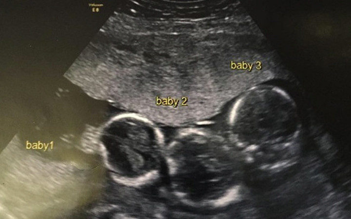 Üçüz bebekler için hastaneye yetiştiler ama doktor inanamadı